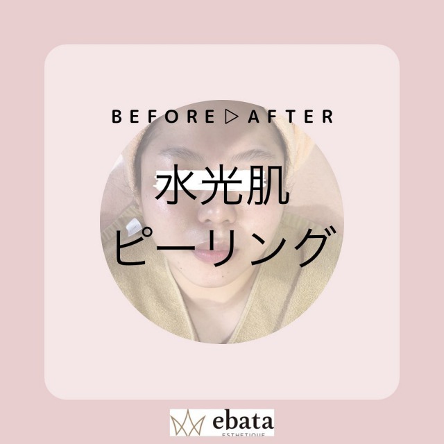 驚きのビフォアアフター!水光ピーリング